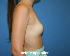 plastic-surgery-breast-augmentation